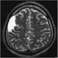MRI（磁気共鳴断層撮影）